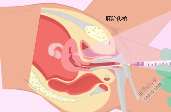 在试管婴儿移植的第10天出现粉红色小出血。