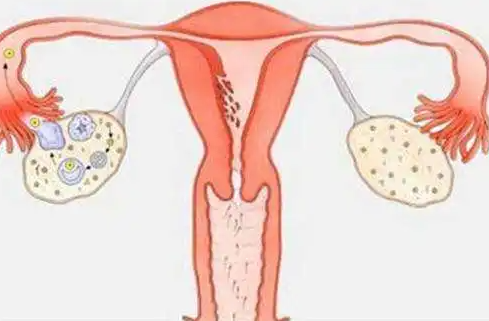 临沂借卵试管助孕-如何治疗多囊卵巢？试管婴儿