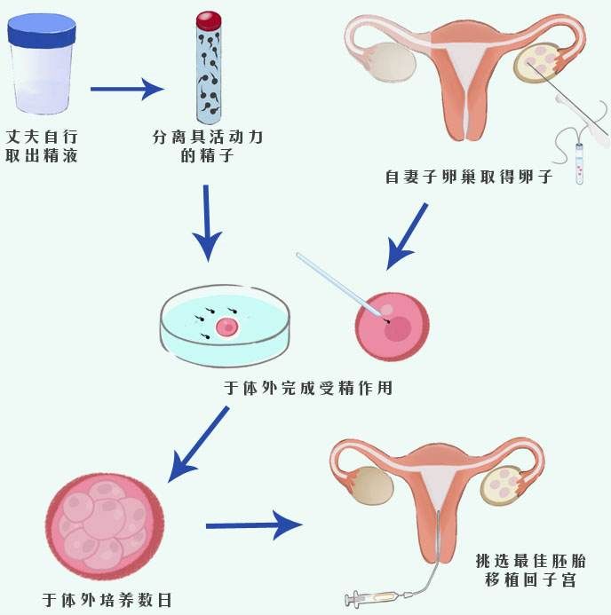 宁波供卵试管助孕包生子费用-试管婴儿和体外受