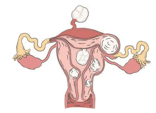 北京40岁合法供卵-子宫肌瘤的病理是什么？